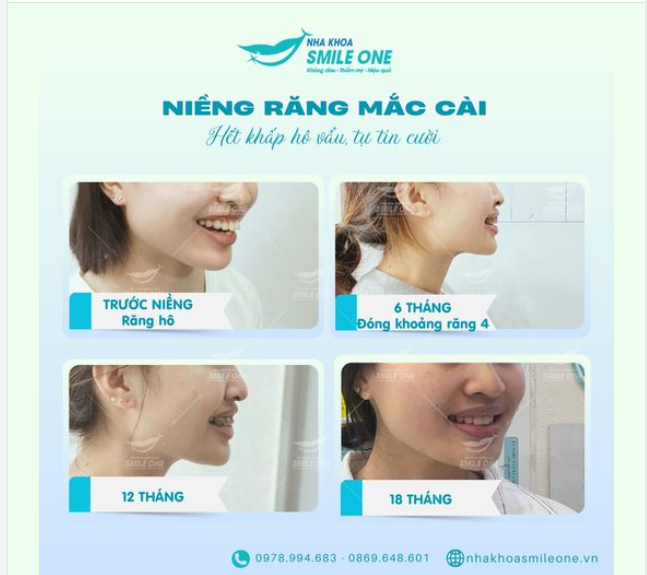 BẠN THÍCH NỤ CƯỜI NÀO HƠN?