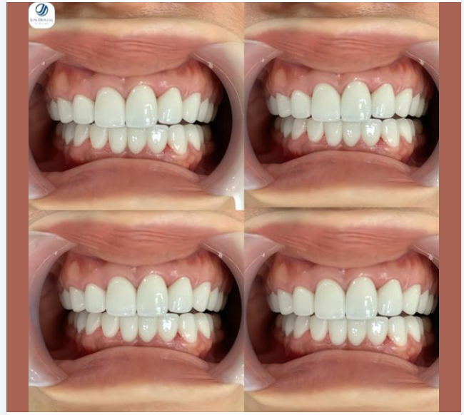 RĂNG SỨ BỀN ĐẸP MÀ "GIÁ CŨNG "ĐẸP"