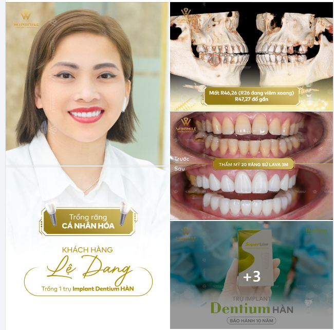 NỤ CƯỜI ĐẸP CÒN CẦN LÀ NỤ CƯỜI KHỎE - CA ĐIỀU TRỊ TRỒNG RĂNG KẾT HỢP THẨM MỸ RĂNG SỨ