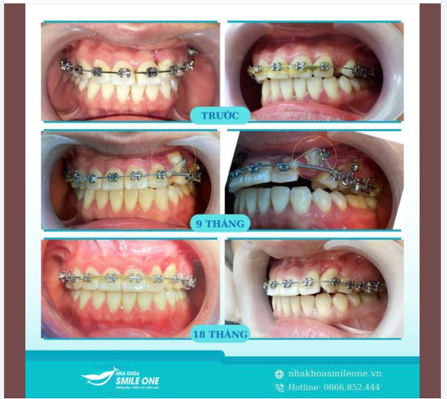 Bạn có bao giờ cảm thấy lúng túng khi vừa hô vừa khấp khểnh? Tình trạng này không chỉ ảnh hưởng đến thẩm mỹ mà còn khiến bạn tự ti trong giao tiếp.