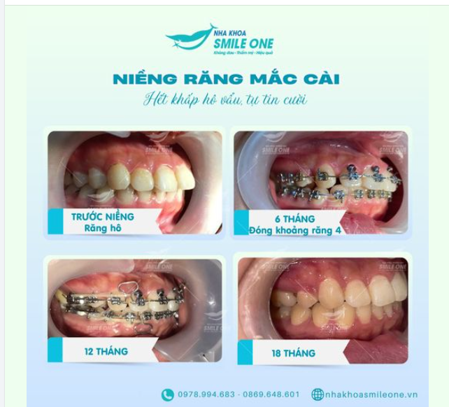 BẠN CÓ TỪNG TỰ TI VÌ HÀM RĂNG HÔ VẨU?