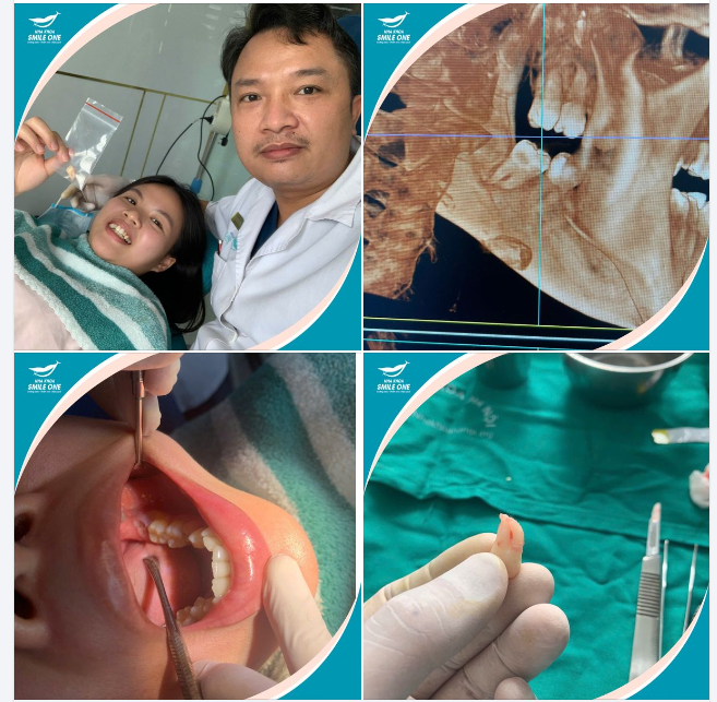 Ths Bs Nguyễn Tuấn Dương vừa thực hiện một ca nhổ răng khôn mọc lệch, chân cong.