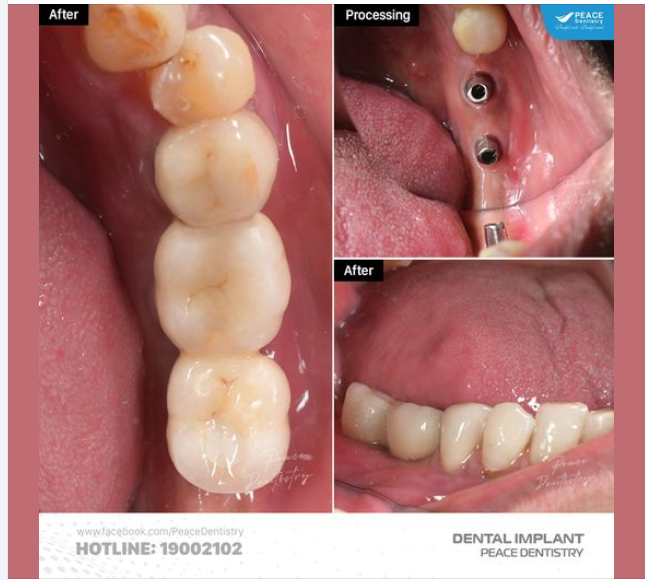 NÊN CHỌN IMPLANT NÀO ĐỂ VỪA ĐẢM BẢO HIỆU QUẢ VỪA PHÙ HỢP VỚI TÀI CHÍNH?