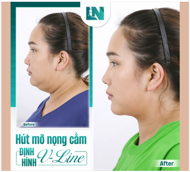 Hút mỡ nọng cằm- Định hình V-Line  30 phút tạo ngay gương mặt thon gọn, tự tin với cằm V-line!