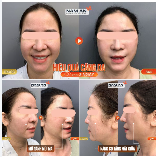 Kết Quả Căng Da Mặt Sau 3 Ngày Tại Nam An