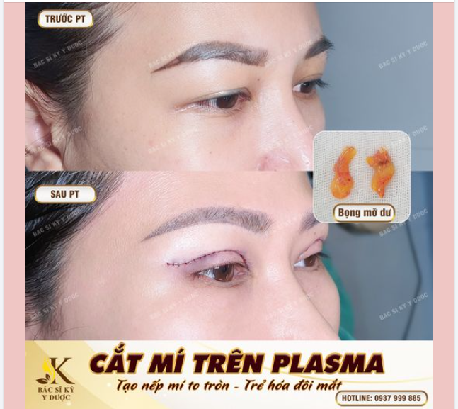 MẮT ĐẸP TRẺ TRUNG NGAY SAU PHẪU THUẬT
