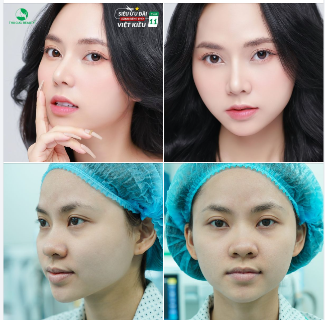Khác biệt khi không nhận ra chính bản thân mình khi nâng mũi tại TC