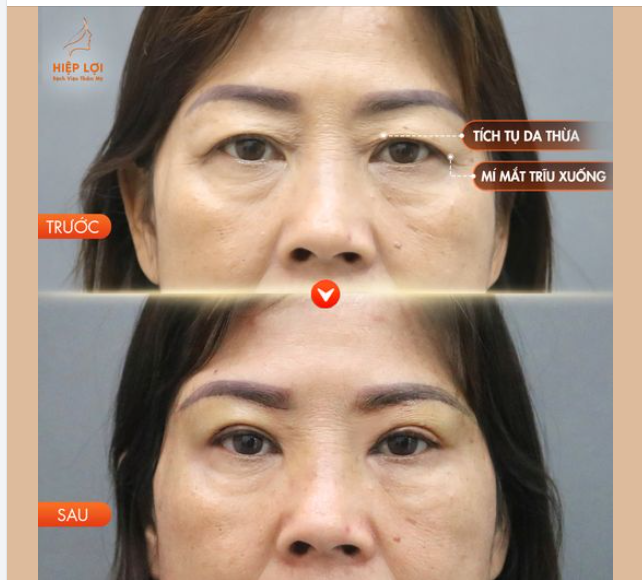 Tích tụ da thừa ở mí mắt thường dẫn đến tình trạng mí mắt bị trĩu, gây cảm giác nặng nề và có thể ảnh hưởng đến tầm nhìn.