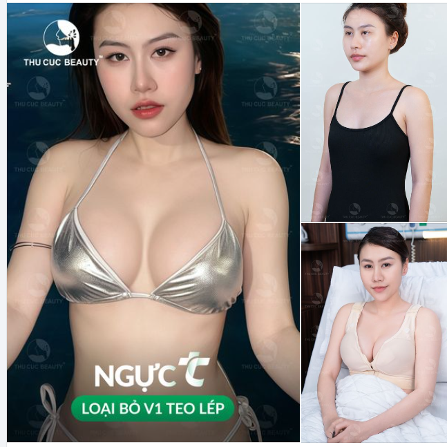 Nhanh tay Upsize V1 cùng ưu đãi 30% cho chị em nâng ngực trong tháng 11