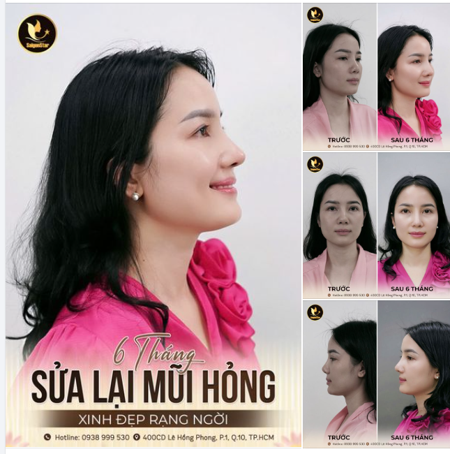 NÂNG MŨI SỤN SƯỜN - GIẢI PHÁP VÀNG KHẮC PHỤC MŨI HỎNG.