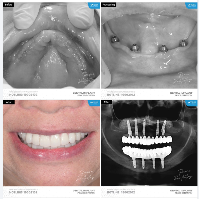 IMPLANT TOÀN HÀM: LỰA CHỌN LÝ TƯỞNG THAY CHO HÀM THÁO LẮP CẦU RĂNG SỨ DÀI