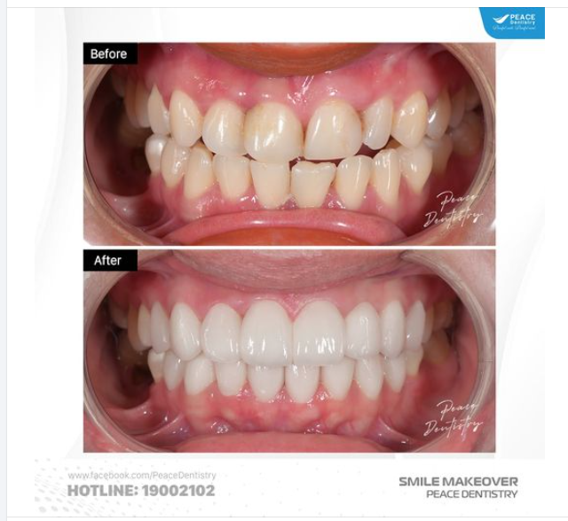 Tình trạng răng ố vàng, thân răng ngắn, hơi xô lệch nhẹ của nữ khách hàng Peace Dentistry được khắc phục hoàn toàn nhờ dán sứ Veneer IPS e.max Press (Germany)