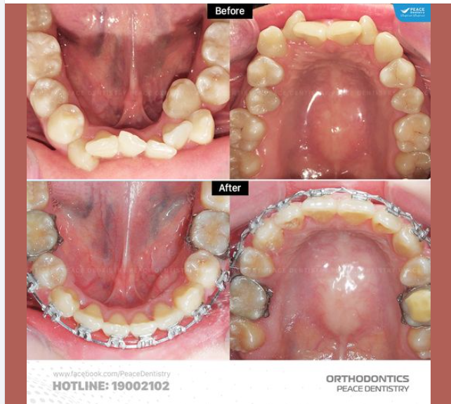SAU 18 THÁNG NIỀNG RĂNG TẠI PEACE DENTISTRY (vẫn đang trong quá trình chỉnh nha), hiệu quả nhận thấy rõ ràng là: