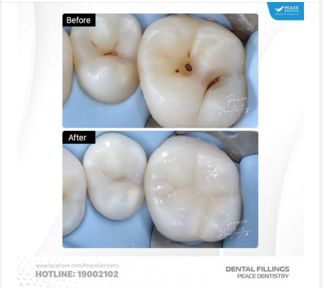 BẠN CÓ BAO GIỜ THẮC MẮC TẠI SAO RĂNG CỬA THƯỜNG KHOẺ MẠNH HƠN TRONG KHI RĂNG HÀM LẠI DỄ BỊ SÂU?