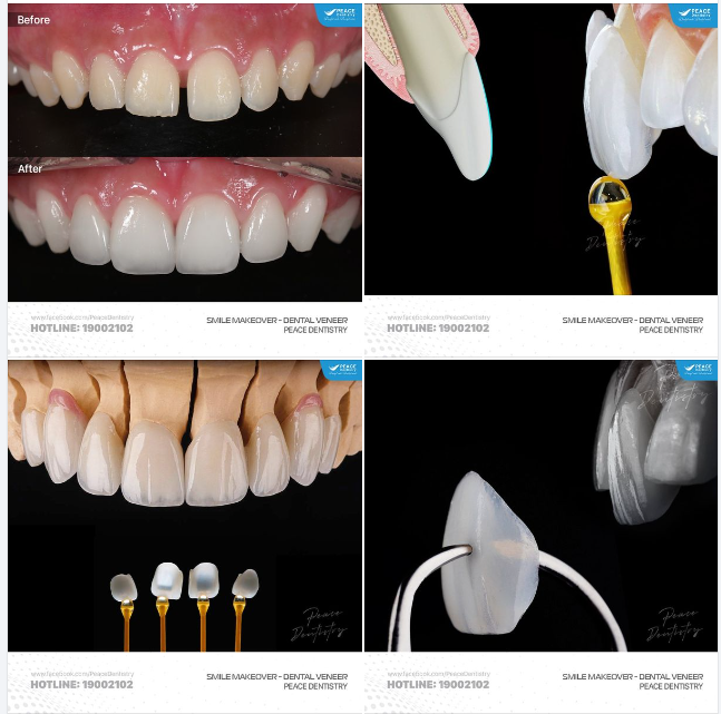 VENEER - LỰA CHỌN TUYỆT VỜI CHO RĂNG THƯA HỞ KẼ