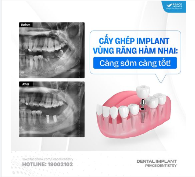 MẤT RĂNG HÀM - IMPLANT LÀ LỰA CHỌN LÝ TƯỞNG, BỀN VỮNG. HÃY THỰC HIỆN CÀNG SỚM CÀNG TỐT!