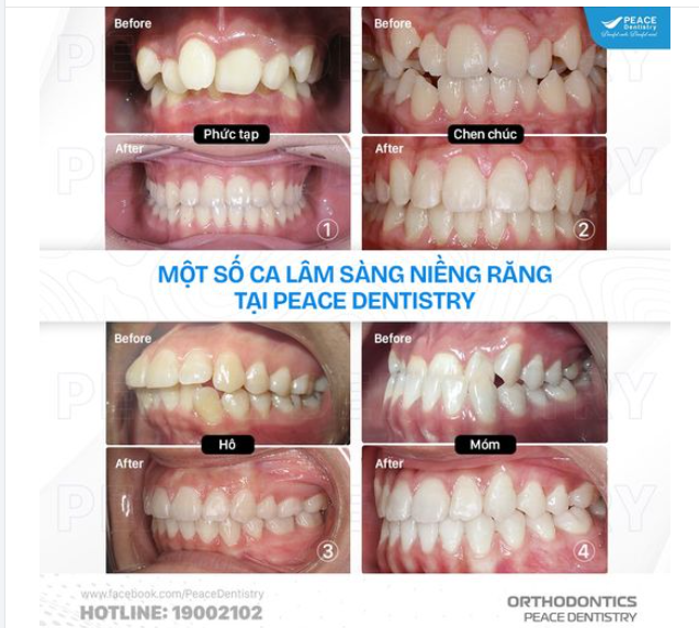 KIÊN TRÌ SẼ MANG LẠI THÀNH CÔNG. Và niềng răng cũng vậy, kết quả đạt được là vô cùng xứng đáng sau bao tháng ngày không từ bỏ nỗ lực của bác sĩ và cả chính bạn!