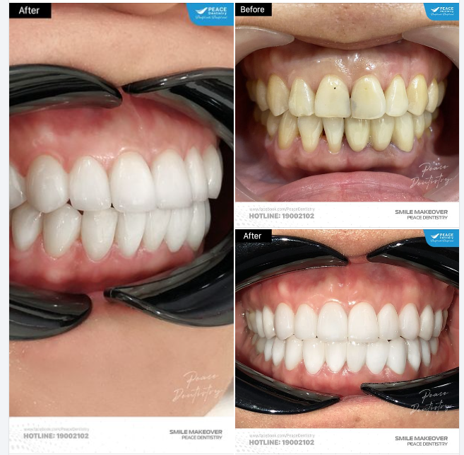 THIẾT KẾ NỤ CƯỜI MỚI với mặt dán sứ Veneer IPS e.max và răng thật gần như được giữ lại trọn vẹn!