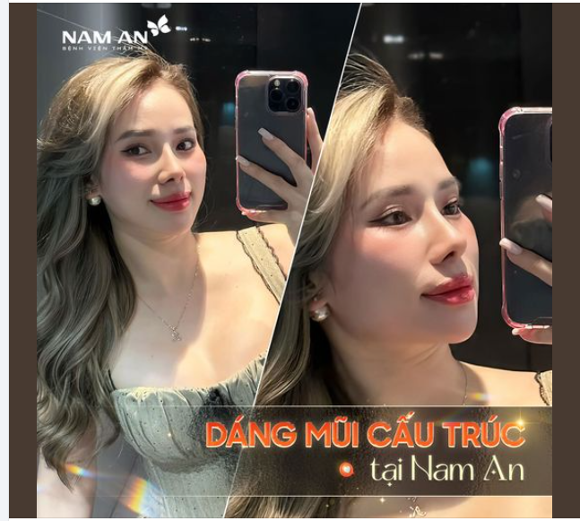 Nâng mũi tại Nam An -Quy trình chuyên nghiệp – Kết quả hoàn mỹ: