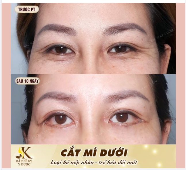 ƯU THẾ CỦA PHƯƠNG PHÁP CẮT MÍ DƯỚI