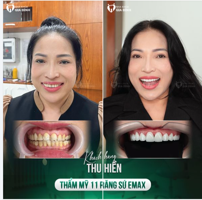 ĐÃ TỰ TIN NAY CÀNG TỰ TIN HƠN NHỜ THAY ĐỔI HÀM RĂNG