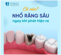 Có nên nhổ răng ngay sau khi phát hiện ra không?