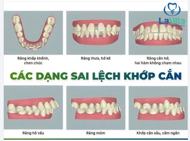 TÌM HIỂU VỀ CÁC TRƯỜNG HỢP SAI LỆCH KHỚP CẮN THƯỜNG GẶP