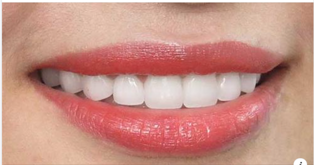 Bọc răng sứ giữ được bao lâu và hướng dẫn chăm sóc sau bọc răng