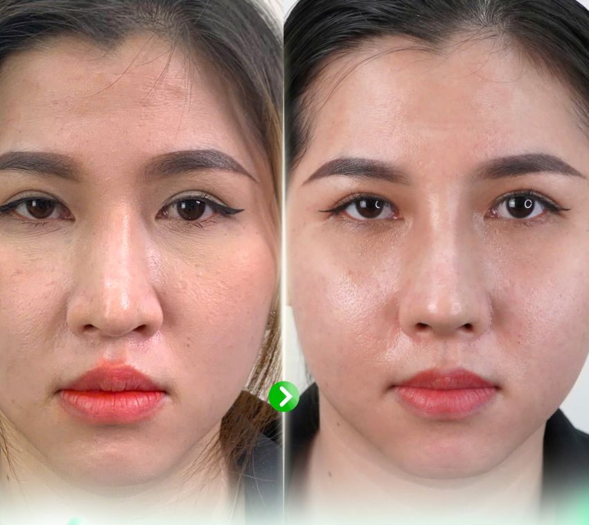 KH GẶP TÌNH TRẠNG MŨI XUỐNG CẤP, GIẢI QUYẾT BẰNG MŨI SỤN SƯỜN