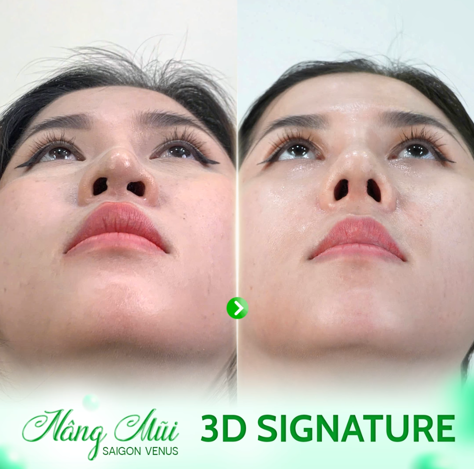 CHỊ KHÁCH HÀNG GẶP BIẾN CHỨNG KHIẾN LỖ MŨI LỆCH, KHÔNG ĐỀU