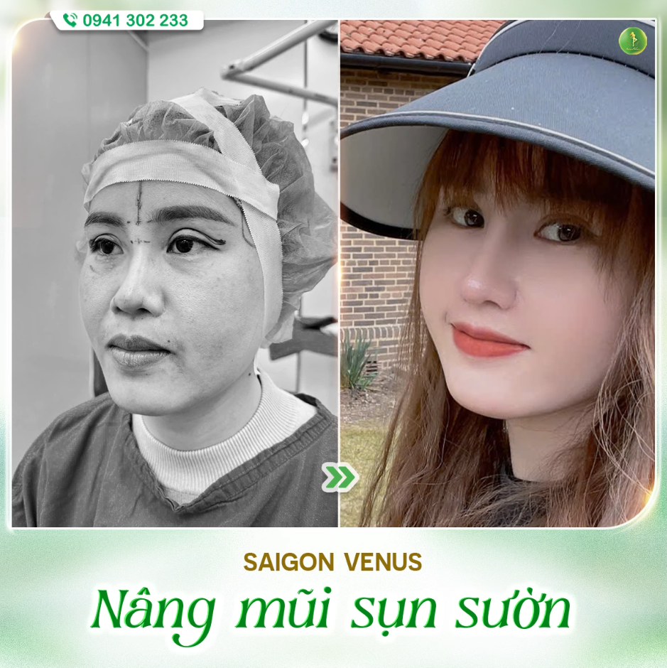 BÍ QUYẾT SỞ HỮU DÁNG MŨI ĐẸP NHƯ "TẠC" CỦA KHÁCH HÀNG SAIGON VENUS