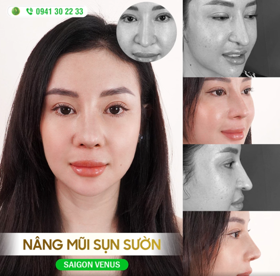 MŨI TUỘT SỐNG, LỘ SỤN THAY ĐỔI VỚI GIẢI PHÁP SỤN SƯỜN