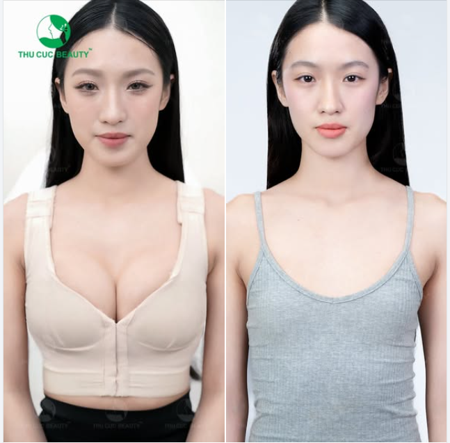 Nâng ngực đón tết