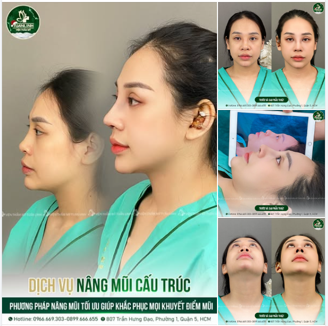 3 LÝ DO NÊN NÂNG MŨI NGAY TỪ BÂY GIỜ