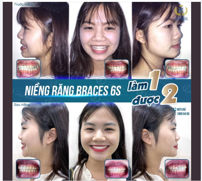 MỪNG NGÀY THÁO NIỀNG - KHÁCH HÀNG NGUYỄN HỒNG NGUYÊN  KHỚP CẮN NGƯỢC, NIỀNG SỚM XINH CÀNG SỚM!