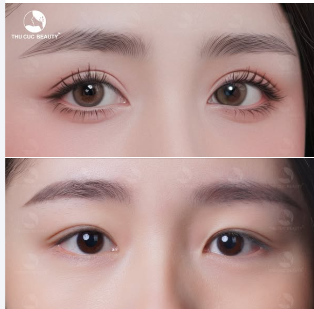 Công nghệ cắt mí Bluelight: Sạch khuẩn. Hồi phục nhanh x2