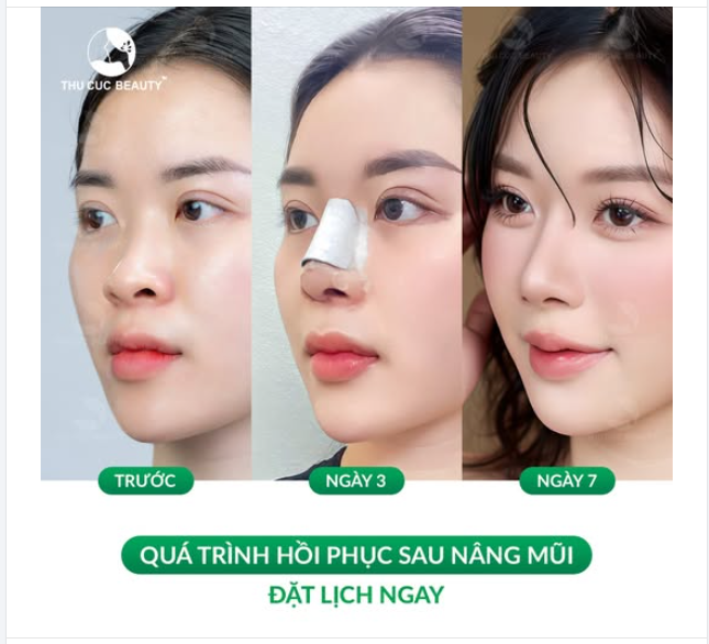 Mũi TC -35% nâng mũi xinh như nàng thơ chỉ có tại Thu Cúc