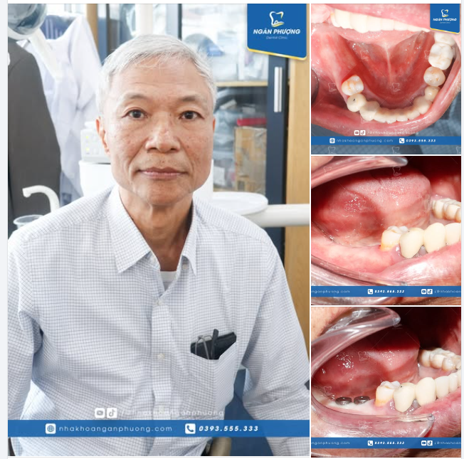 Implant vẫn là chân ái