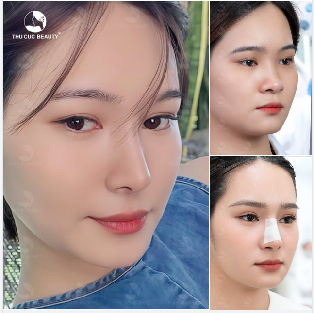 Nâng mũi TC Thực hiện bởi bác sĩ uy tín tại phòng mổ vô khuẩn chuẩn Quốc tế.