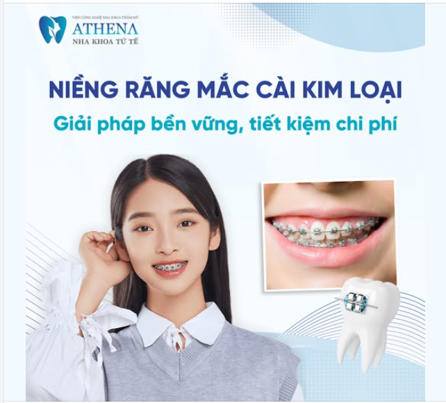 Niềng răng mắc cài kim loại - Giải pháp bền vững, chi phí hợp lý