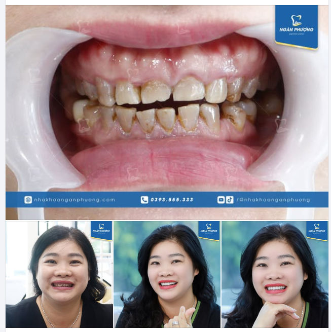 Răng sứ khỏe đẹp là như thế nào?