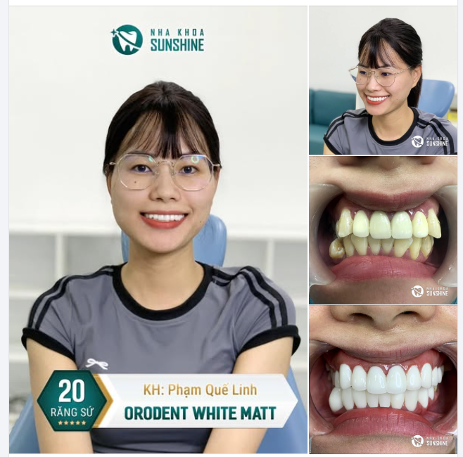 "Thật không ngờ sau khi gỡ bỏ lớp sứ cũ, chị lại có thể sở hữu nụ cười đẹp tự nhiên như thế này!"