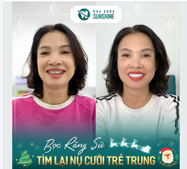 Hơn nửa cuộc đời sống chung với hàm răng nhiều khuyết điểm, giờ đây chị Phạm Thị Diễn đã hoàn toàn lột xác nụ cười của mình!