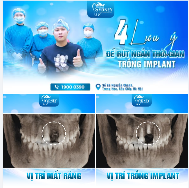 4 LƯU Ý ĐỂ RÚT NGẮN THỜI GIAN TRỒNG IMPLANT