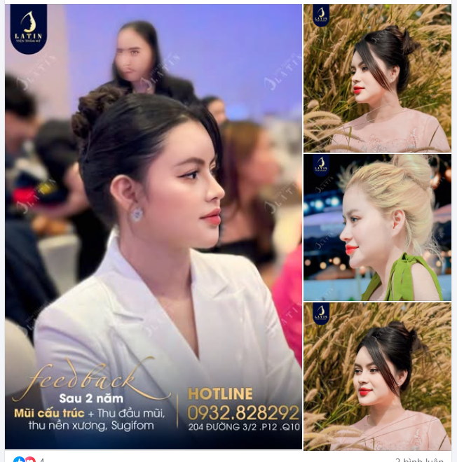 Em gái "biến hình" cực xinh sau gần 2 năm nâng mũi cấu trúc tại Latin