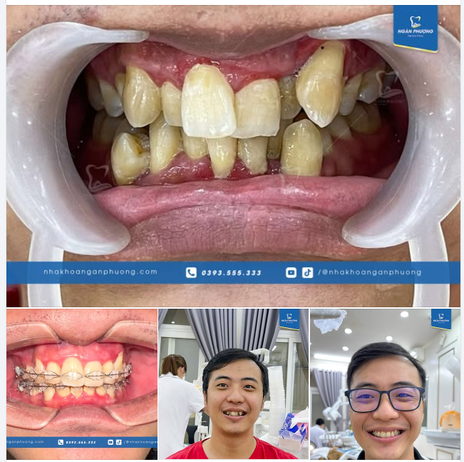 Một case chỉnh nha chưa hoàn thiện nhưng thấy thành quả dần hiện hình là động lực tăng gấp cả trăm ngàn lần