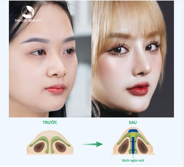 Hình ảnh đáng yêu trước và sau nâng mũi
