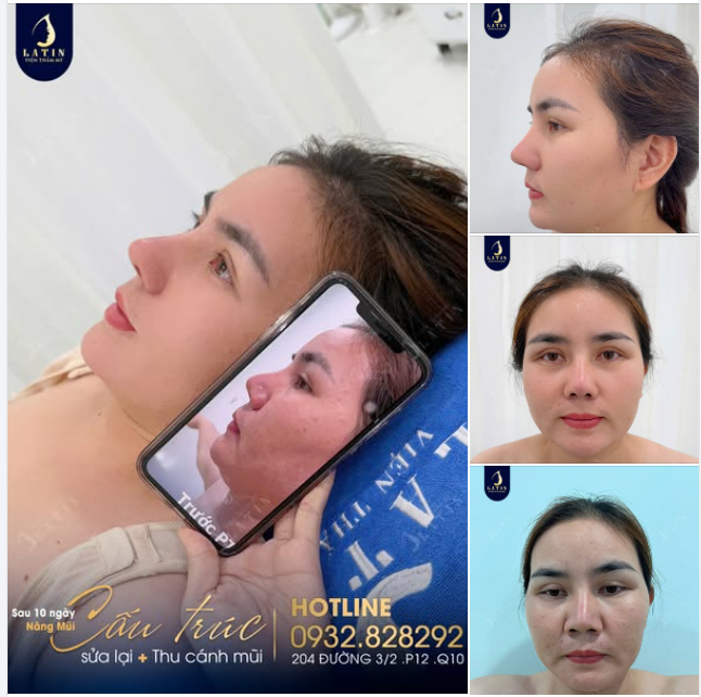Thay đổi nhan sắc cho một năm mới khởi sắc Kết quả mũi cấu trúc sửa lại sau 10 ngày cho chị gái đến từ Bình Định