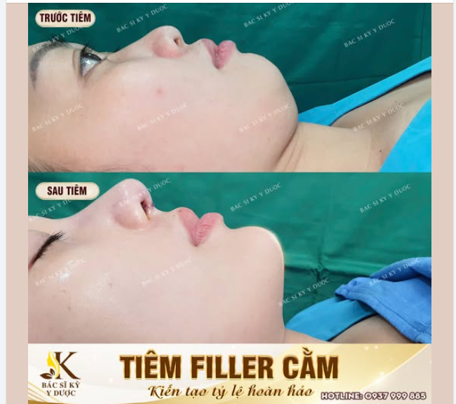 Chỉ sau 15 phút nắn chỉnh cho nàng một dáng cằm siêu tự nhiên.