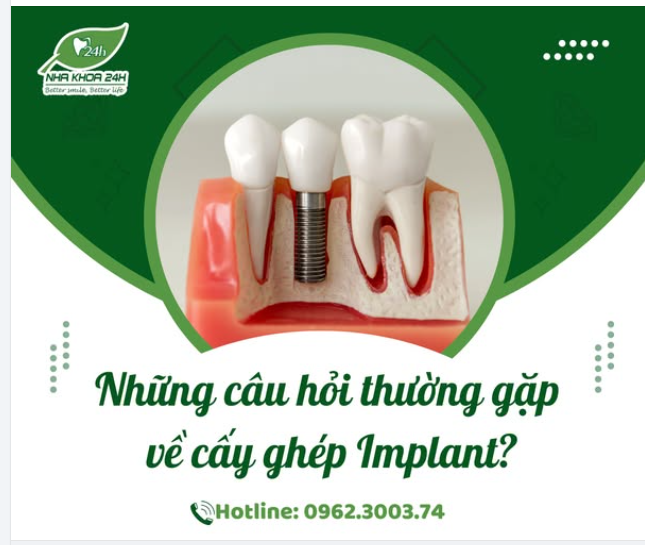 GIẢI ĐÁP NHỮNG CÂU HỎI THƯỜNG GẶP KHI CẤY GHÉP RĂNG IMPLANT TRONG MẤT RĂNG